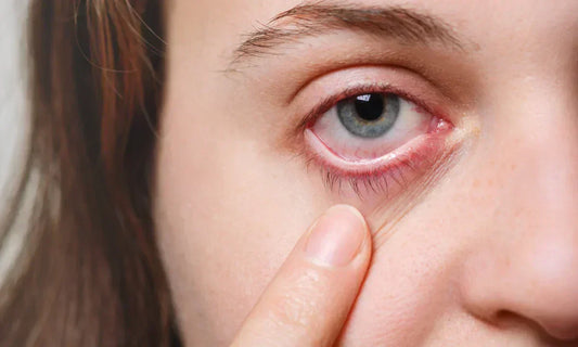 conditions-misdiagnosed-as-pink-eye