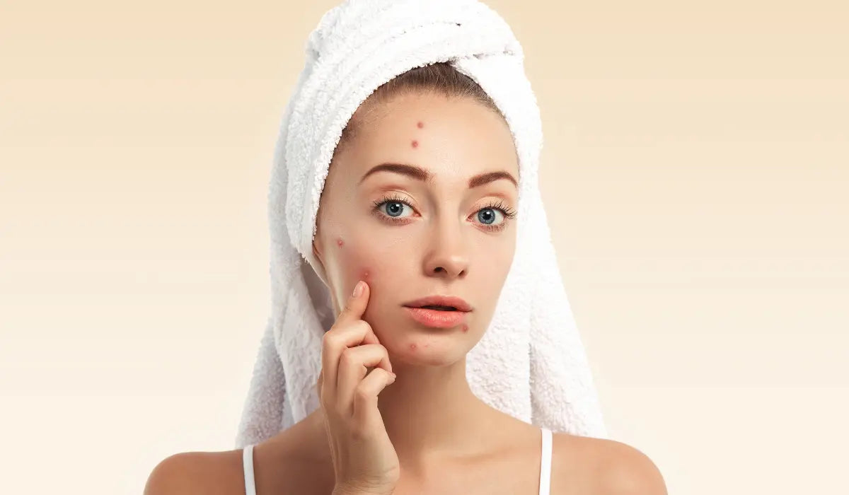 Probiotics for Acne: Is Gut Balance the Missing Link?